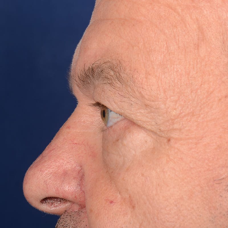 Eyelid Surgery Before & After Gallery - Patient 397663 - Image 5