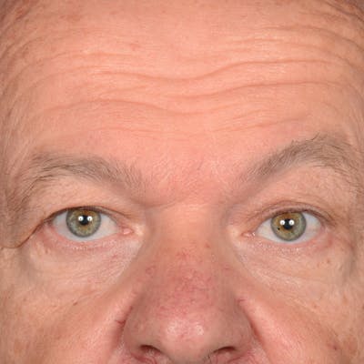 Eyelid Surgery Before & After Gallery - Patient 397663 - Image 1