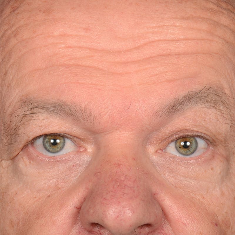 Eyelid Surgery Before & After Gallery - Patient 397663 - Image 1