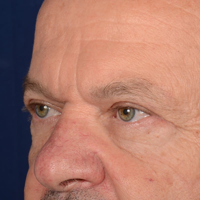 Eyelid Surgery Before & After Gallery - Patient 397663 - Image 4