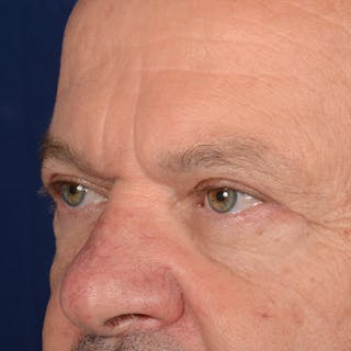 Eyelid Surgery Before & After Gallery - Patient 397663 - Image 4