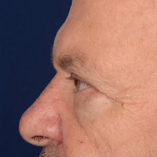 Eyelid Surgery Before & After Gallery - Patient 397663 - Image 6