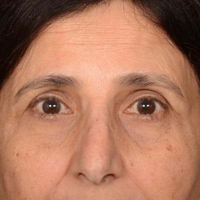 Browlift Before & After Gallery - Patient 285543 - Image 1