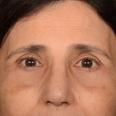 Browlift Before & After Gallery - Patient 285543 - Image 2