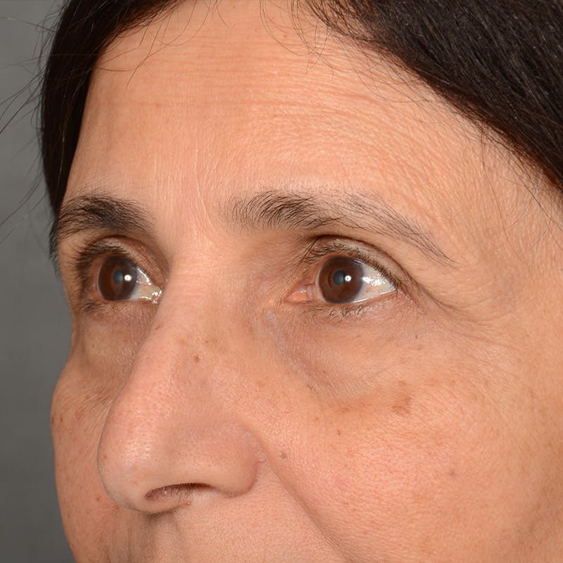 Browlift Before & After Gallery - Patient 285543 - Image 3