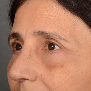 Browlift Before & After Gallery - Patient 285543 - Image 4