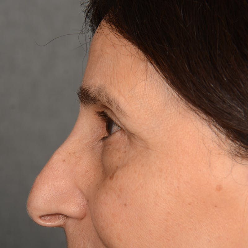 Browlift Before & After Gallery - Patient 285543 - Image 5