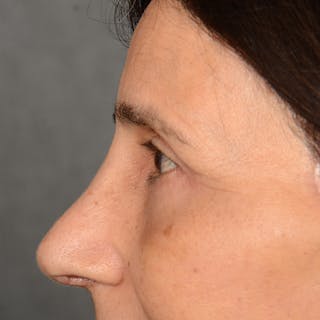 Browlift Before & After Gallery - Patient 285543 - Image 6