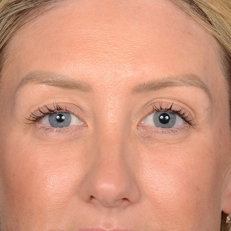 Browlift Before & After Gallery - Patient 188101 - Image 1