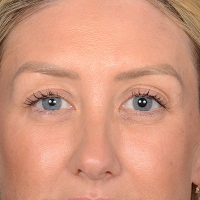 Browlift Before & After Gallery - Patient 188101 - Image 1