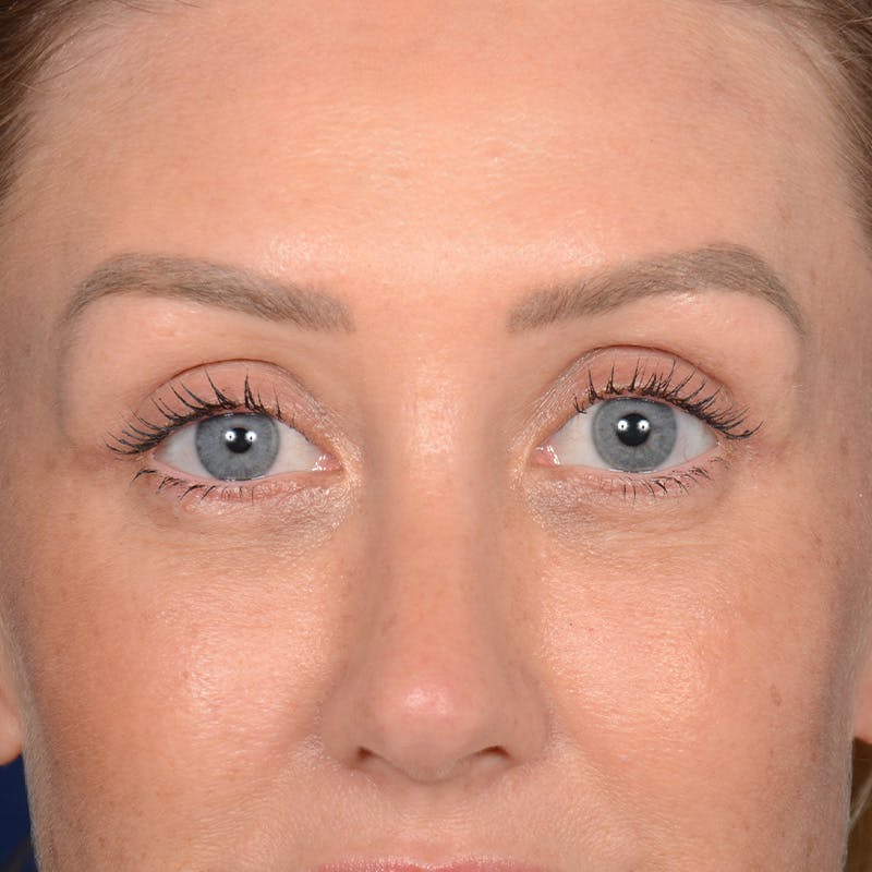 Browlift Before & After Gallery - Patient 188101 - Image 2