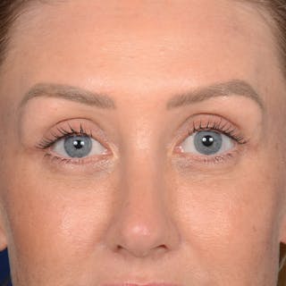 Browlift Before & After Gallery - Patient 188101 - Image 2