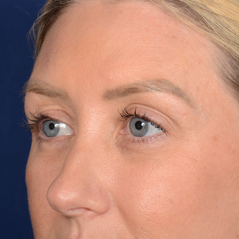 Browlift Before & After Gallery - Patient 188101 - Image 3
