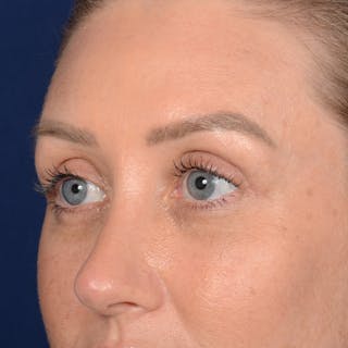 Browlift Before & After Gallery - Patient 188101 - Image 4