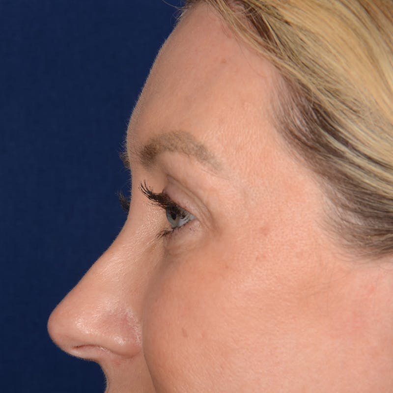 Browlift Before & After Gallery - Patient 188101 - Image 5