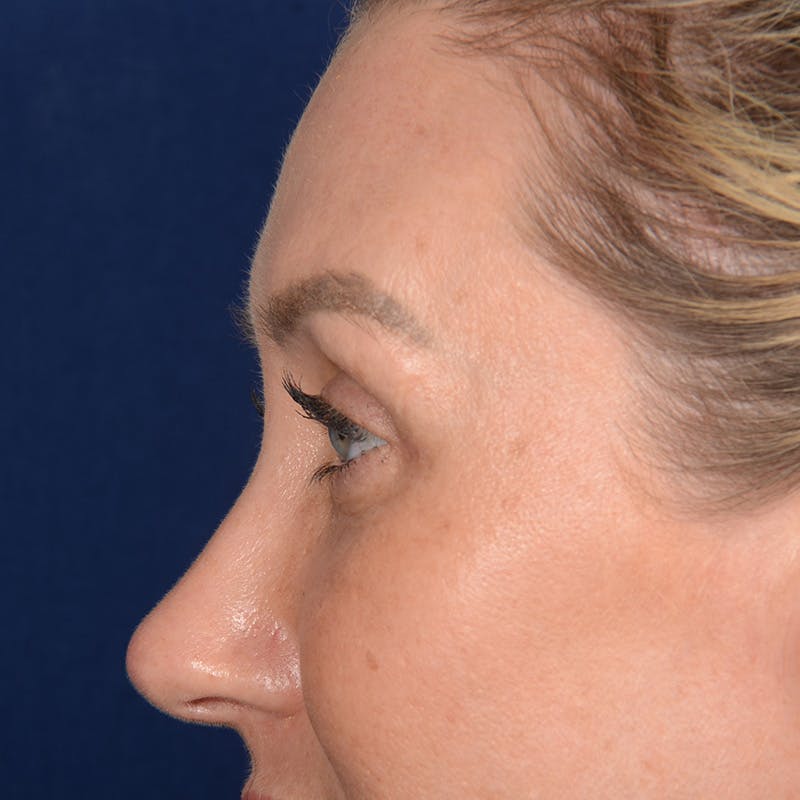 Browlift Before & After Gallery - Patient 188101 - Image 6