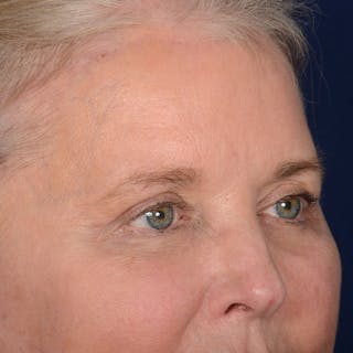 Browlift Before & After Gallery - Patient 257017 - Image 4