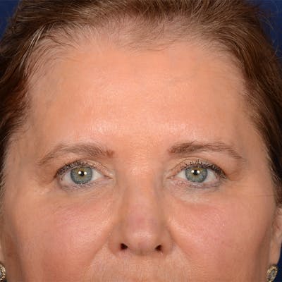 Browlift Before & After Gallery - Patient 257017 - Image 1
