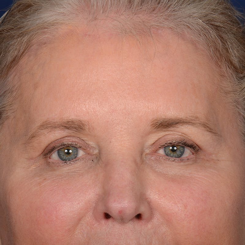 Browlift Before & After Gallery - Patient 257017 - Image 2
