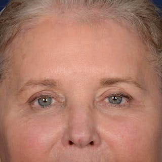 Browlift Before & After Gallery - Patient 257017 - Image 2