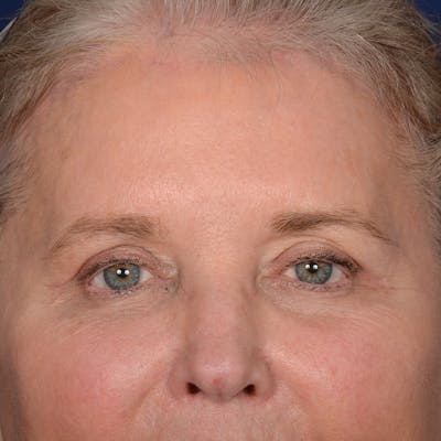 Browlift Before & After Gallery - Patient 257017 - Image 2