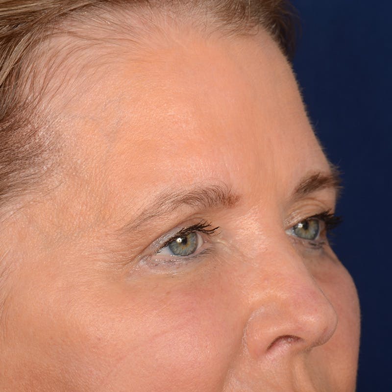 Browlift Before & After Gallery - Patient 257017 - Image 3