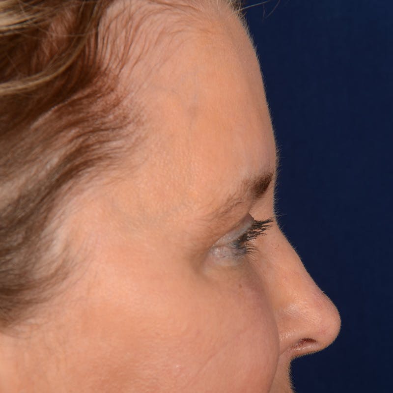 Browlift Before & After Gallery - Patient 257017 - Image 5