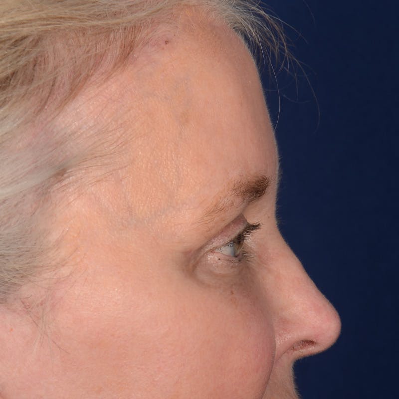 Browlift Before & After Gallery - Patient 257017 - Image 6