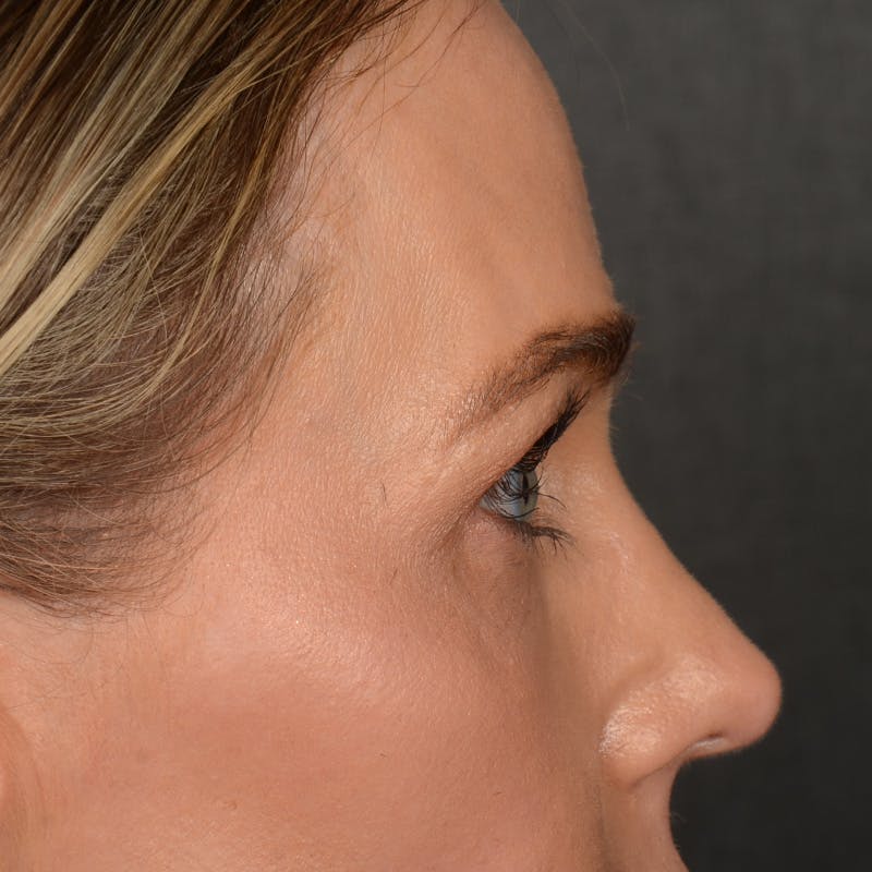 Browlift Before & After Gallery - Patient 425006 - Image 5