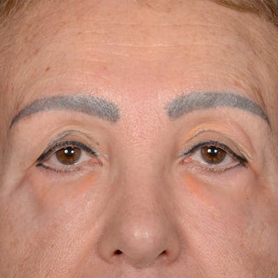 Eyelid Surgery Before & After Gallery - Patient 151381 - Image 1