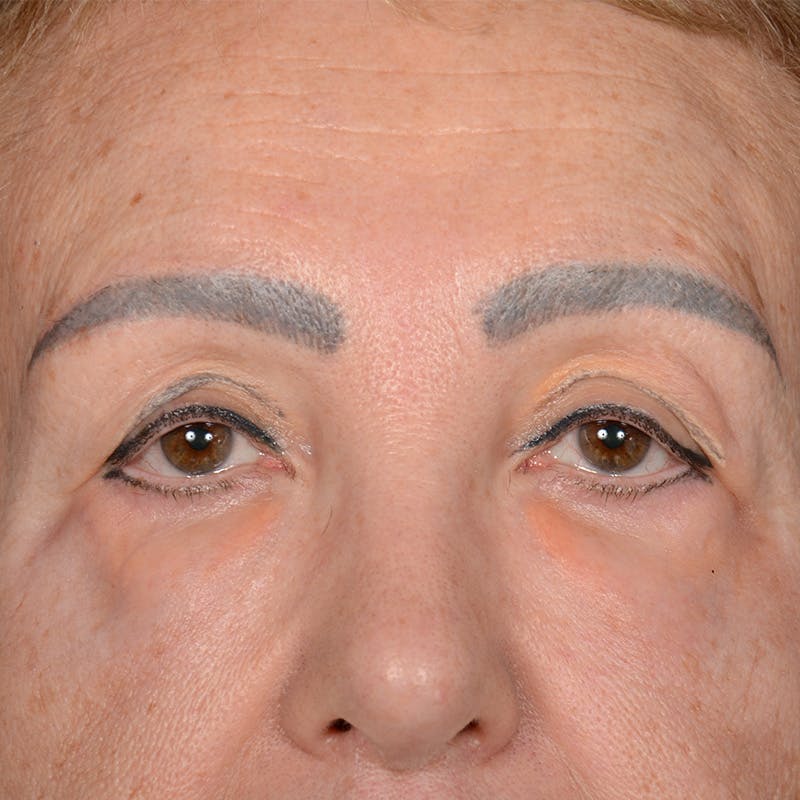 Eyelid Surgery Before & After Gallery - Patient 151381 - Image 1