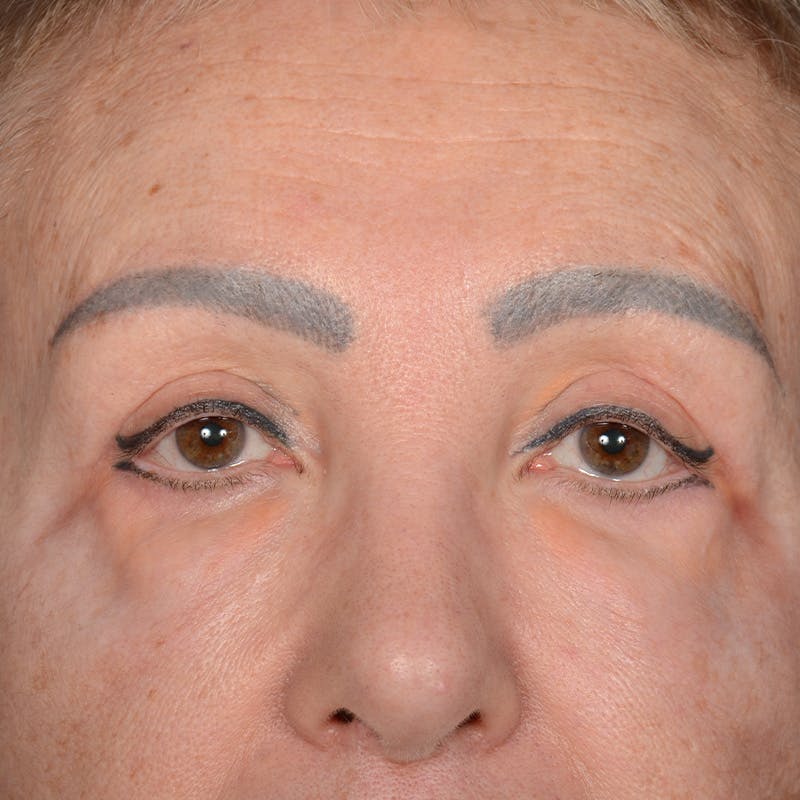Eyelid Surgery Before & After Gallery - Patient 151381 - Image 2
