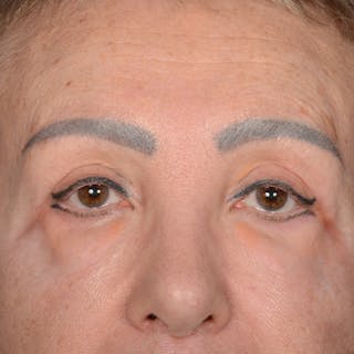 Eyelid Surgery Before & After Gallery - Patient 151381 - Image 2
