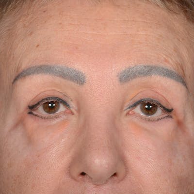Eyelid Surgery Before & After Gallery - Patient 151381 - Image 2
