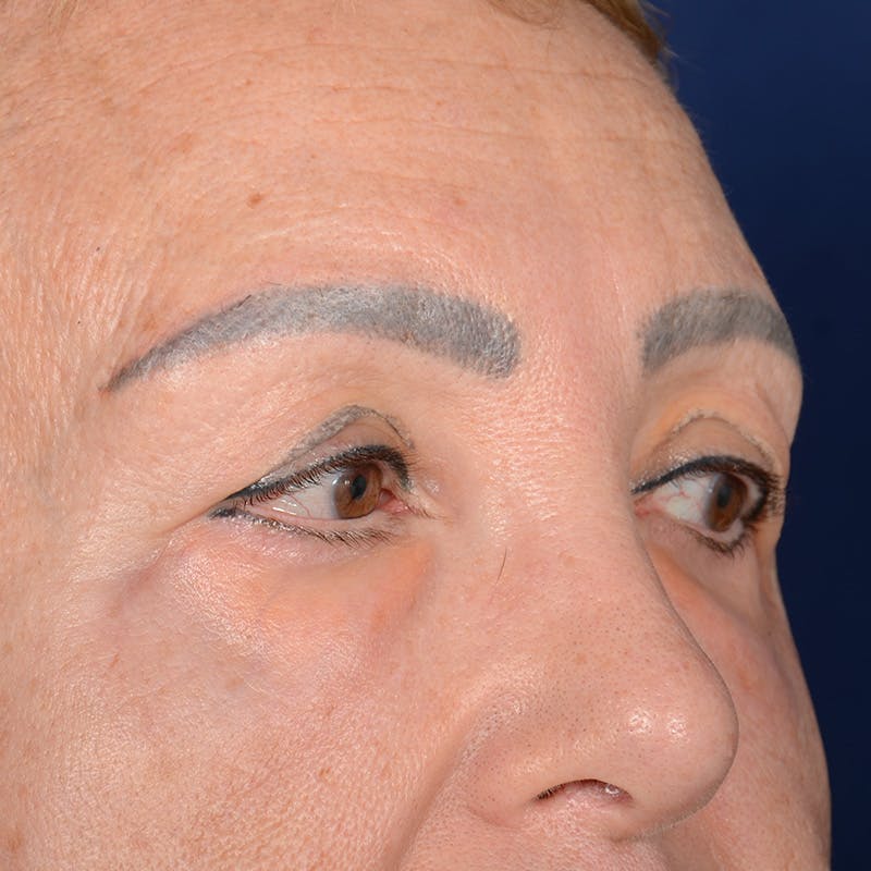 Eyelid Surgery Before & After Gallery - Patient 151381 - Image 3