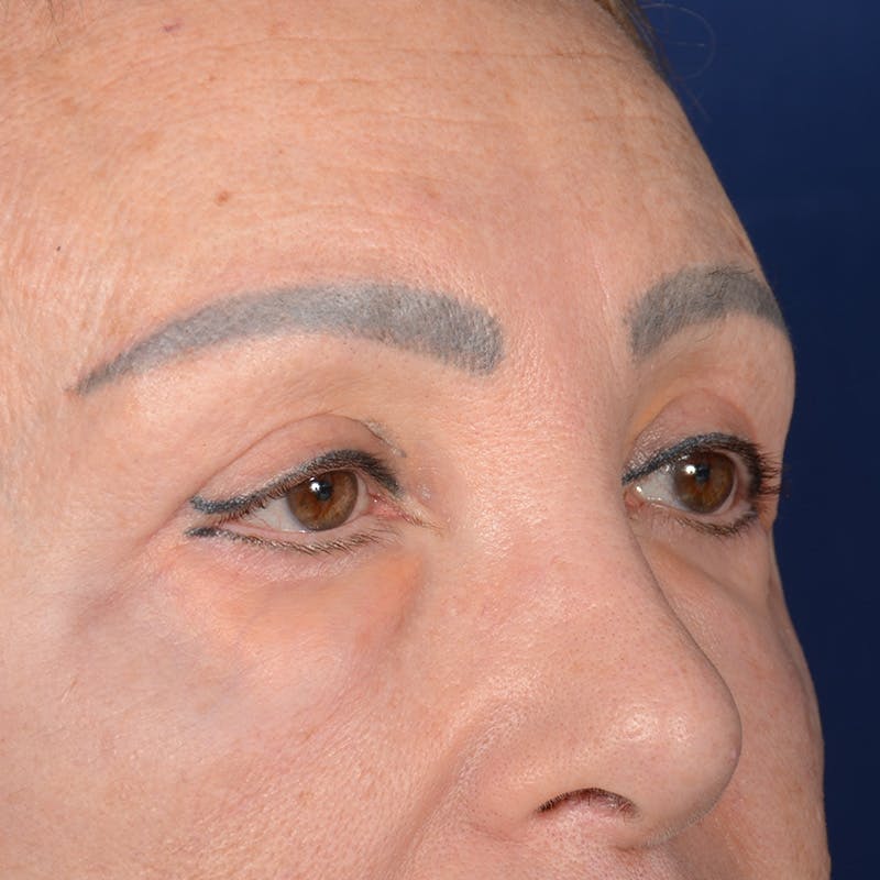 Eyelid Surgery Before & After Gallery - Patient 151381 - Image 4