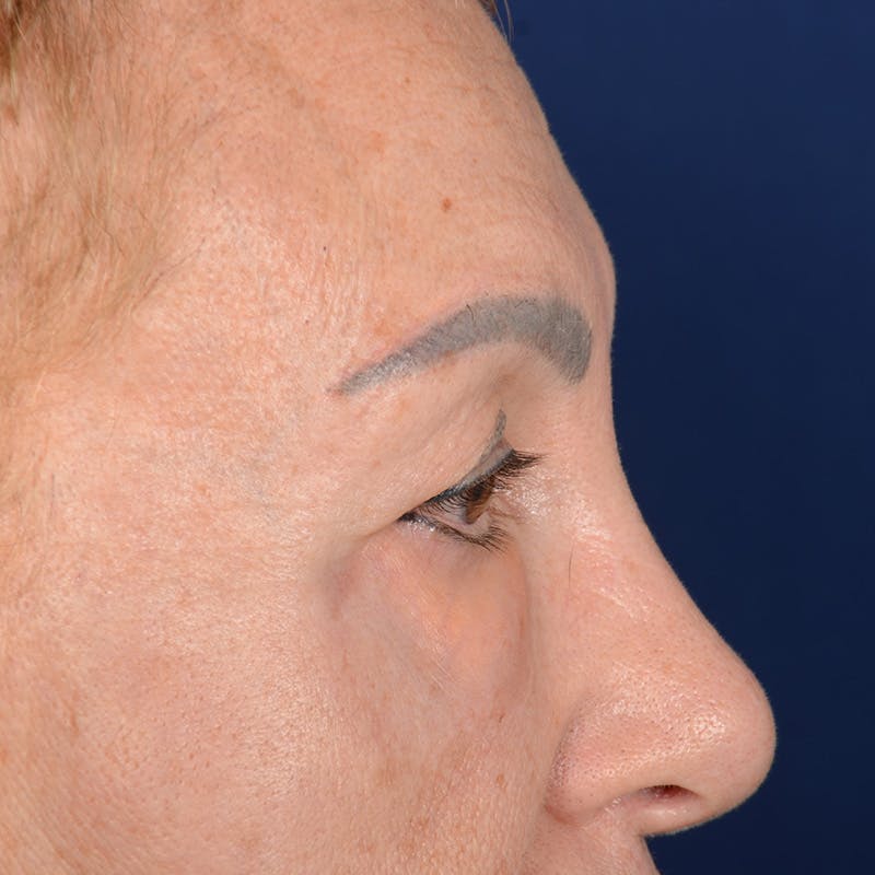 Eyelid Surgery Before & After Gallery - Patient 151381 - Image 5