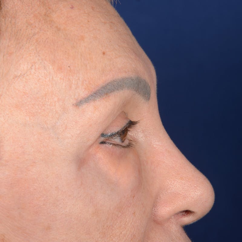 Eyelid Surgery Before & After Gallery - Patient 151381 - Image 6