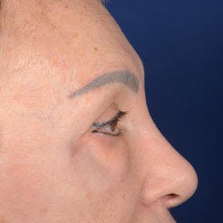 Eyelid Surgery Before & After Gallery - Patient 151381 - Image 6