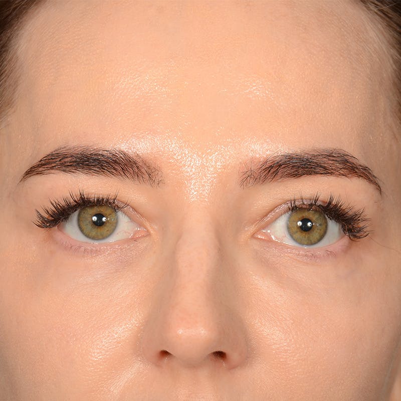 Browlift Before & After Gallery - Patient 185458 - Image 1