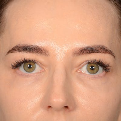 Browlift Before & After Gallery - Patient 185458 - Image 1