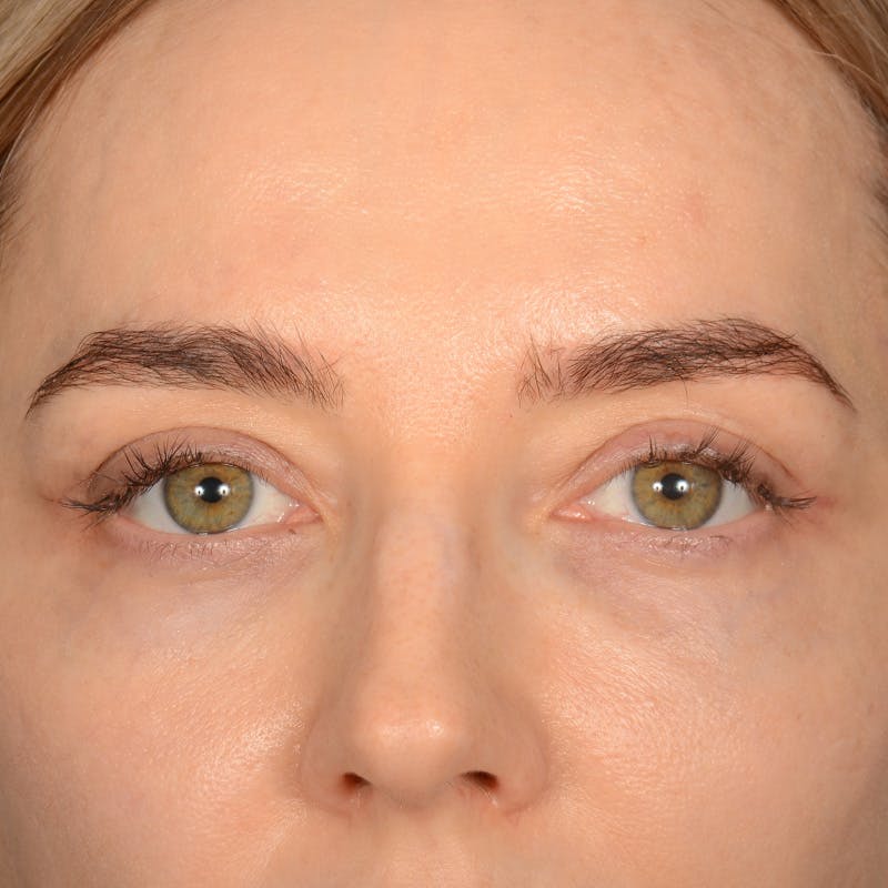 Browlift Before & After Gallery - Patient 185458 - Image 2