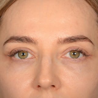 Browlift Before & After Gallery - Patient 185458 - Image 2