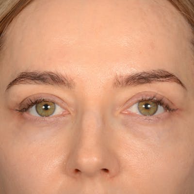 Browlift Before & After Gallery - Patient 185458 - Image 2