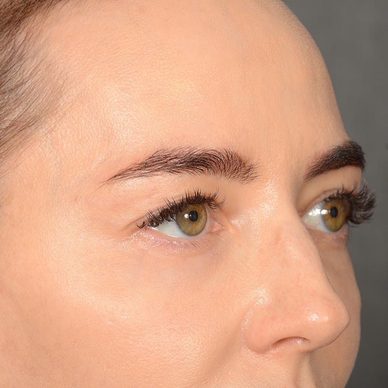 Browlift Before & After Gallery - Patient 185458 - Image 3
