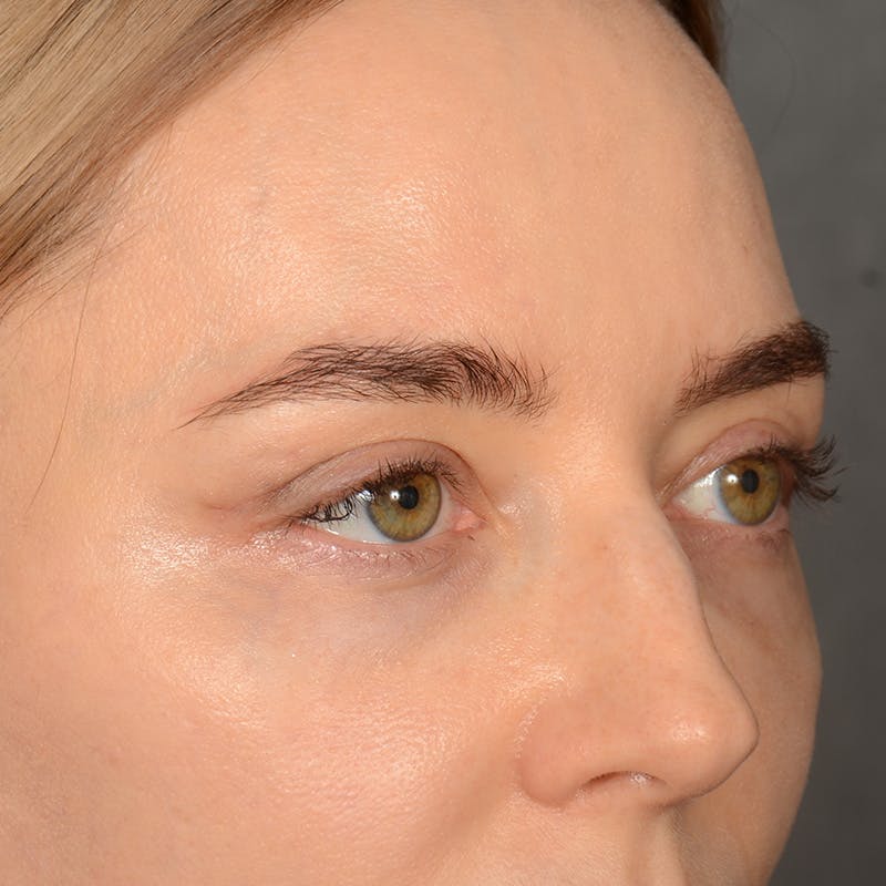 Browlift Before & After Gallery - Patient 185458 - Image 4