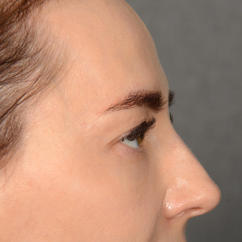 Browlift Before & After Gallery - Patient 185458 - Image 5
