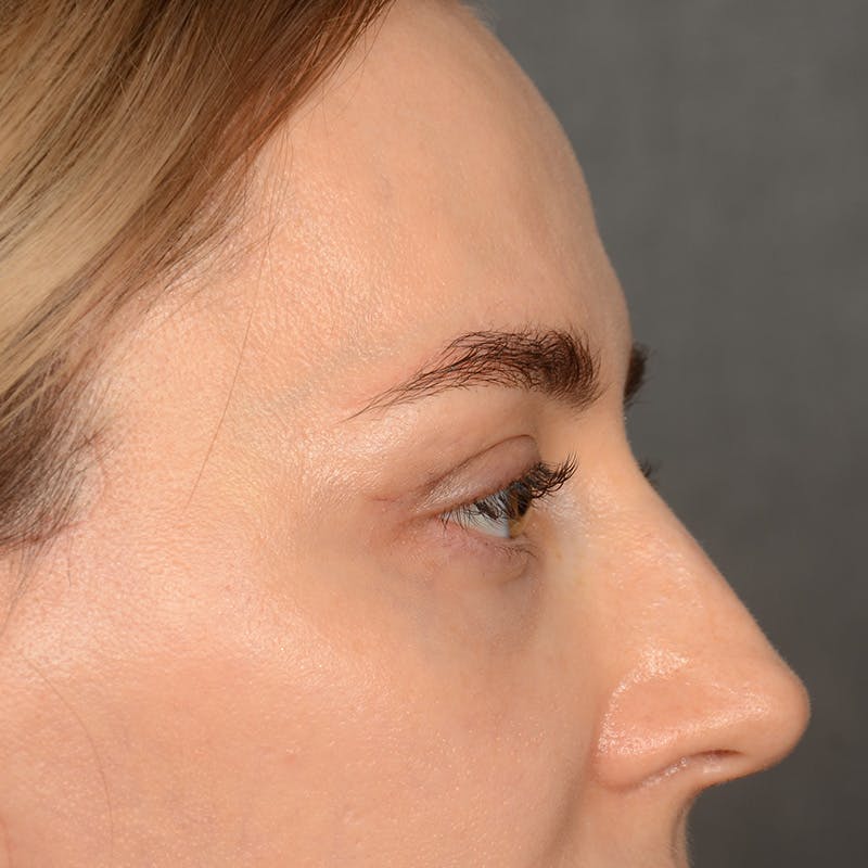 Browlift Before & After Gallery - Patient 185458 - Image 6