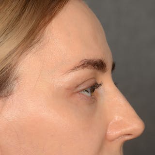 Browlift Before & After Gallery - Patient 185458 - Image 6