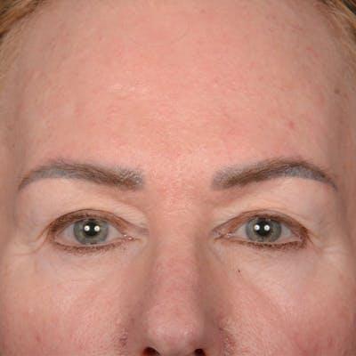 Eyelid Surgery Before & After Gallery - Patient 361513 - Image 1